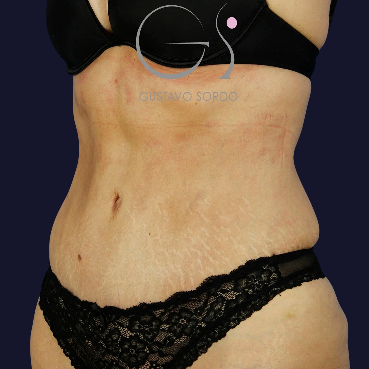 Después de abdominoplastia y liposucción, Dr. Gustavo Sordo