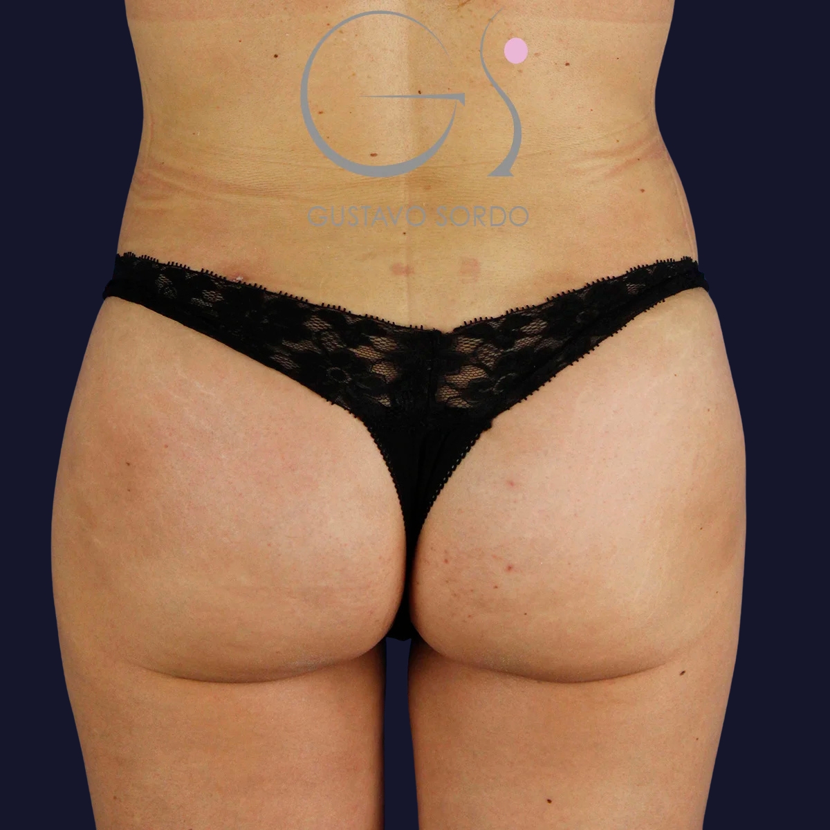 Después de lipofilling de glúteos, Dr. Gustavo Sordo