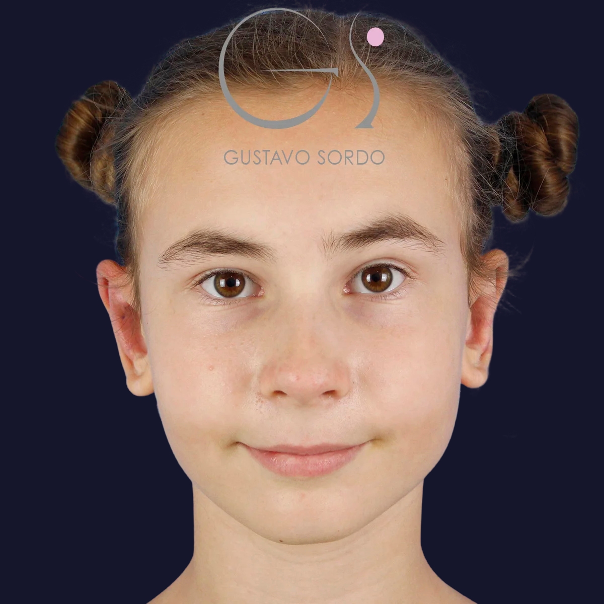 Después de otoplastia, Dr. Gustavo Sordo