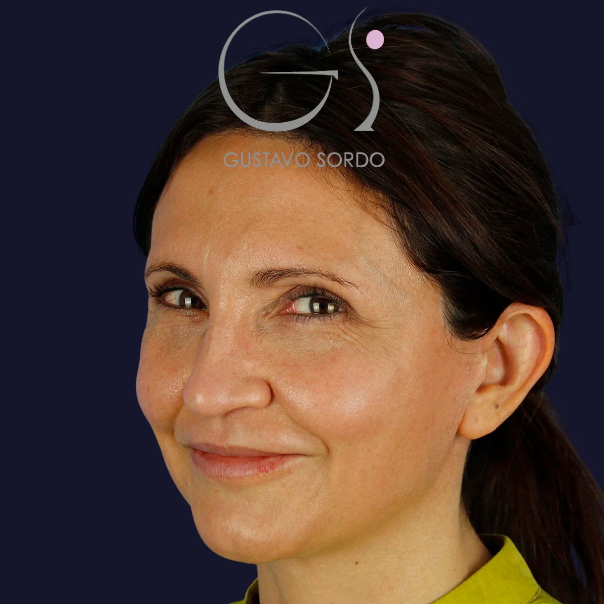 Antes y despues lifting facial, Dr. Gustavo Sordo, Madrid