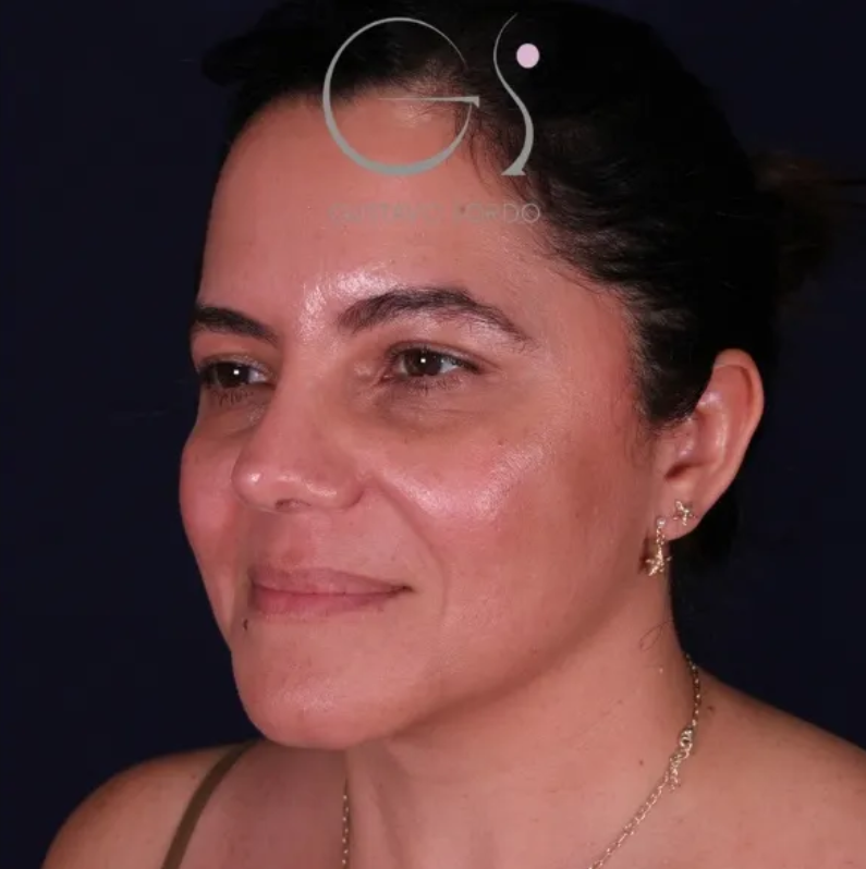 Antes y despues rinoplastia nariz latina con injerto de cartílago costal, Dr. Gustavo Sordo, Madrid